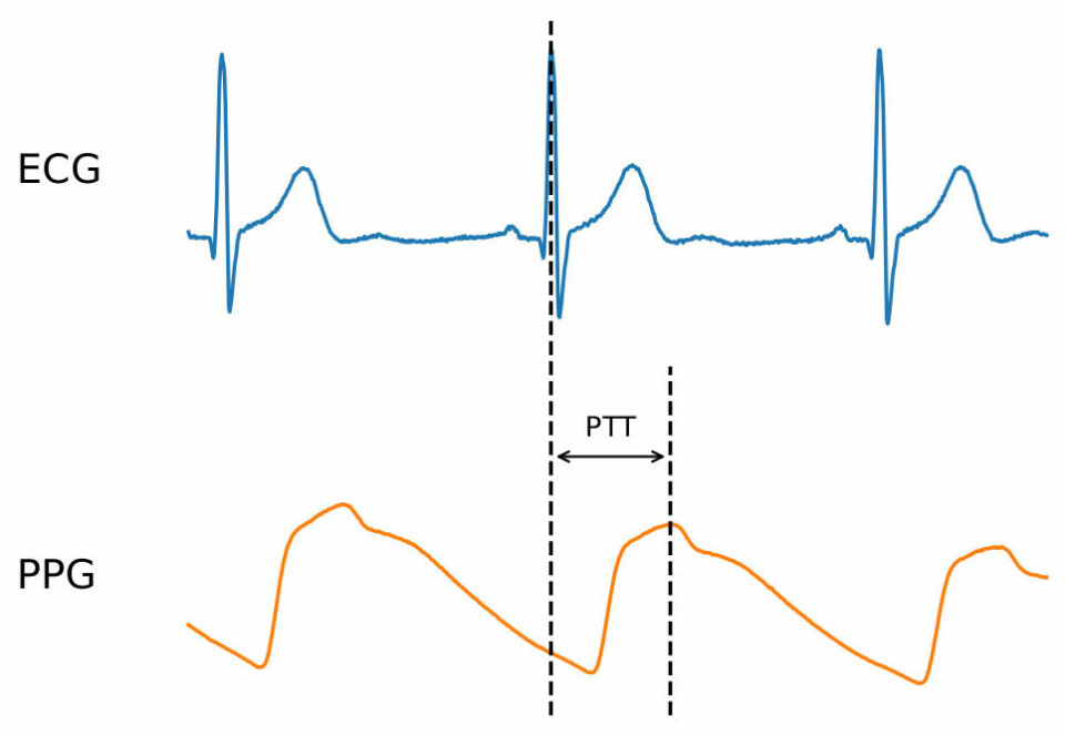Måling av Pulsatile Transit Time som tiden fra en EKG-sensor på brystet detekterer et hjerteslag til en PPG-sensor detekterer maks blodvolum i en blodåre, for eksempel ved håndleddet. Illustrasjon: Fredrik Flornes Ellertsen