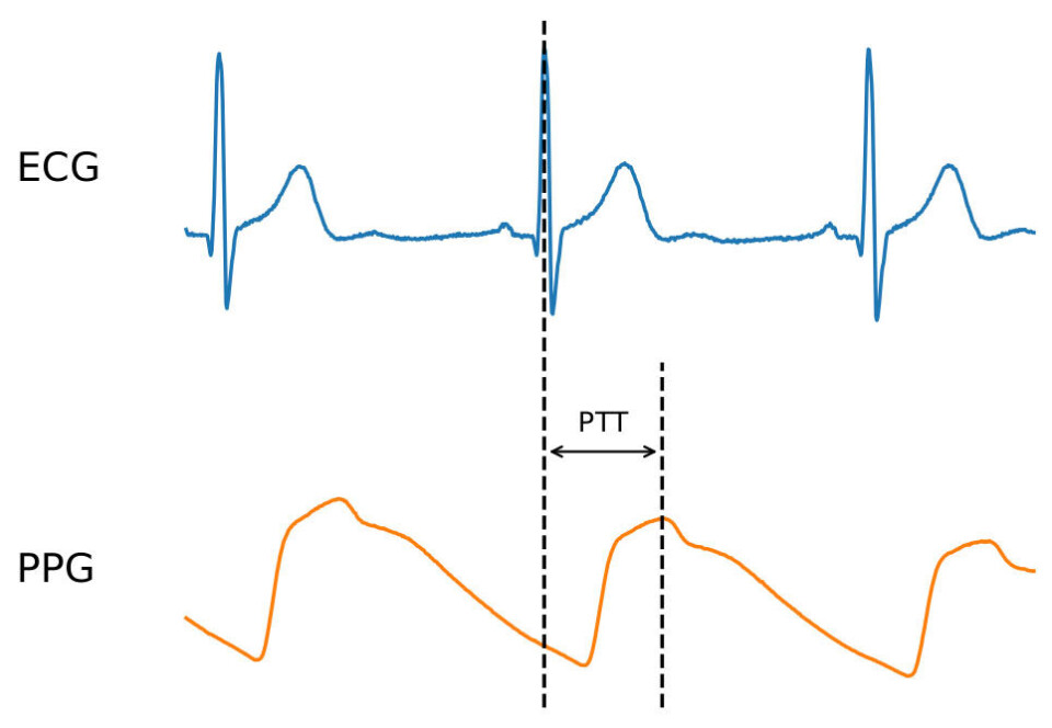 Måling av Pulsatile Transit Time som tiden fra en EKG-sensor på brystet detekterer et hjerteslag til en PPG-sensor detekterer maks blodvolum i en blodåre, for eksempel ved håndleddet. Illustrasjon: Fredrik Flornes Ellertsen Måling av Pulsatile Transit Time som tiden fra en EKG-sensor på brystet detekterer et hjerteslag til en PPG-sensor detekterer maks blodvolum i en blodåre, for eksempel ved håndleddet. Illustrasjon: Fredrik Flornes Ellertsen