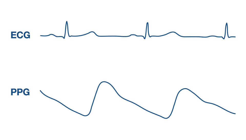 Figur 1: EKG-spor kan bestemme HRV, da toppintervaller spores med høyere nøyaktighet sammenlignet med PPG, som er bedre egnet for gjennomsnittlig hjertefrekvensmåling. Figur 1: EKG-spor kan bestemme HRV, da toppintervaller spores med høyere nøyaktighet sammenlignet med PPG, som er bedre egnet for gjennomsnittlig hjertefrekvensmåling.