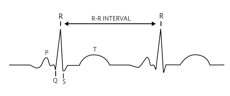 Figur 1: EKG-basert QRS-bølgesignatur gir klinikere og kardiologer viktig informasjon om pasientens helse.